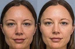 What Age is Best for Fillers in Dubai