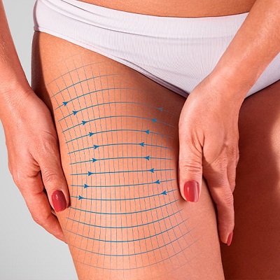 What Are The Pros and Cons of a Thigh Lift?