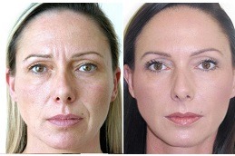 What Layer Of Skin Is Botox Injected For Wrinkles in Dubai