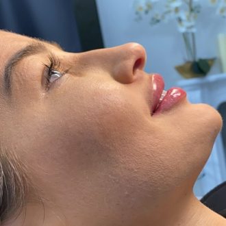 What are the Different Types of Lip Fillers Injections?