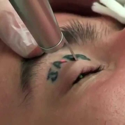 What is the Best Laser Treatment for Tattoo Removal in Dubai Cost