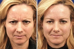 Why Do You Glow After Botox in Dubai