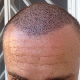 Why Hair Pieces When Start the Surgery of Hair Transplant