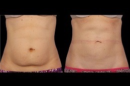 Will CoolSculpting Help Me Lose Weight in Dubai