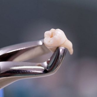 Wisdom Tooth Extraction in Dubai & Abu Dhabi