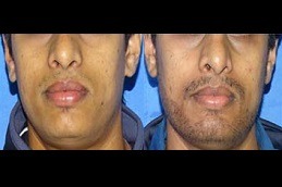 Beard Hairs And Mustache Transplant Are Same Or Not Clinic in Abu Dhabi
