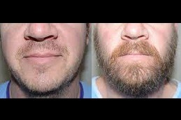 Beard Hairs And Mustache Transplant Are Same Or Not in Dubai