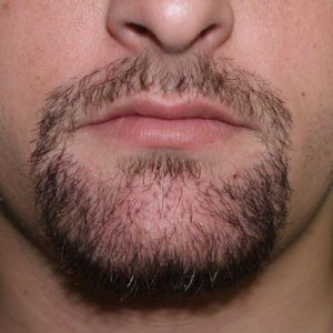Beard Hairs And Mustache Transplant Are Same Or Not?