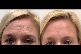 Best Botox For Forehead Wrinkles in Dubai