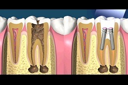 Best Can An Infected Root Canal Heal in Dubai