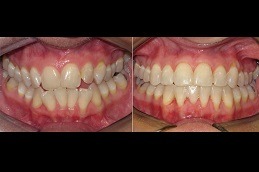 Best Can Braces Be Attractive Clinic in Dubai
