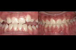 Best Can Braces Be Attractive in Dubai