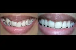 Best Can I Brush My Teeth With Ceramic Braces Clinic in Dubai