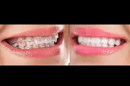 Best Can I Brush My Teeth With Ceramic Braces in Dubai