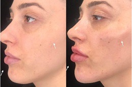 Best Can Kybella Make Chin Bigger Clinic in Dubai
