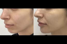 Best Can Kybella Make Chin Bigger in Dubai