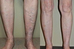 Best Can Varicose Vein Treatments Cause Blood Clots Clinic in Dubai
