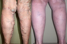 Best Can Varicose Vein Treatments Cause Blood Clots in Dubai