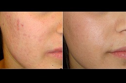 Best Does Laser Scar Removal Work On Brown Skin Clinic in Dubai