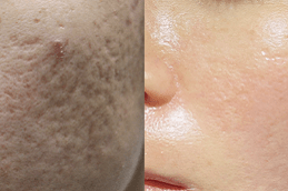 Best Does Laser Scar Removal Work On Brown Skin in Dubai