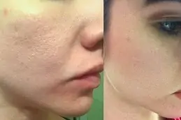 Best Does Retinol Shrink Pores Clinic in Dubai