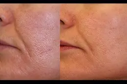 Best Does Retinol Shrink Pores in Dubai