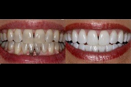 Best Does Whitening Weaken Your Teeth in Dubai