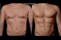 Best Everything You Need To Know About High-Definition Liposculpture in Dubai