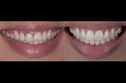 Best How Long Do Implant Teeth Last in Dubai