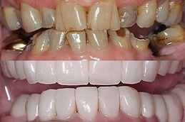 Best How Many Implants Can Be Done At Once Clinic in Dubai