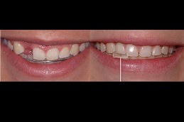 Best How Many Teeth Can an Implant Hold in Dubai