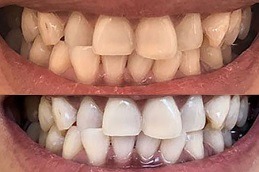 Best Is Dental Whitening Worth It Clinic in Dubai