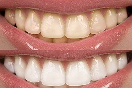 Best Is Dental Whitening Worth It in Dubai