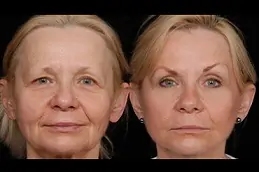 Best Liquid FaceLift Procedure, Cost and Risks Clinic in Dubai