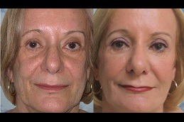 Best Liquid FaceLift Procedure, Cost and Risks in Dubai