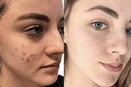 Best The Dos and Don'ts of Salicylic Acid Peeling Clinic in Dubai