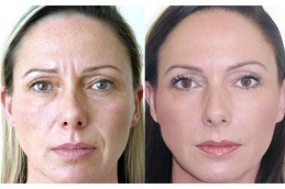 Botulinum Toxin Injections For Facial Wrinkles Clinic in Abu Dhabi