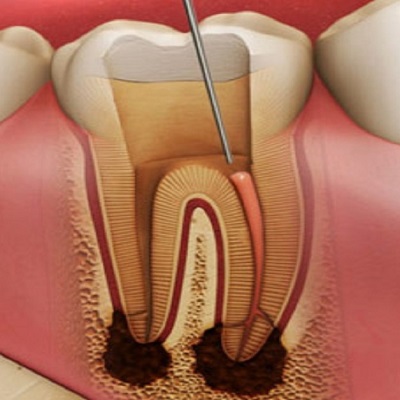 Can An Infected Root Canal Heal in Dubai?
