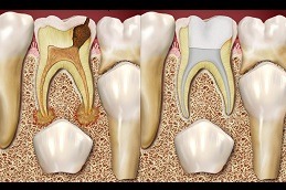 Can An Infected Root Canal Heal in Dubai