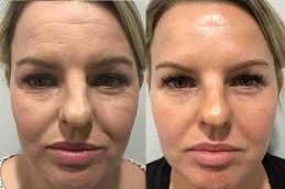 Can Botox Lift Your Face Clinic in Abu Dhabi
