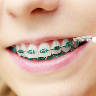 Can Braces Be Attractive in Dubai & Abu Dhabi