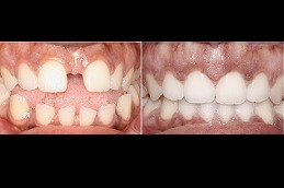 Can Braces Be Attractive in Dubai