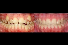 Can I Brush My Teeth With Ceramic Braces in Dubai