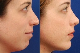 Can Kybella Make Chin Bigger in Dubai