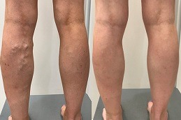 Can Varicose Vein Treatments Cause Blood Clots in Dubai