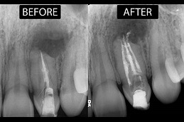 Can an Endodontist Save a Tooth in Dubai