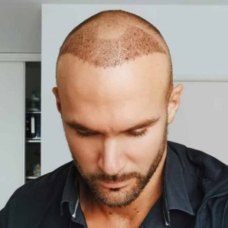 Does DHI Heal Quicker or Slowly in Dubai