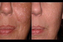 Does Laser Scar Removal Work On Brown Skin in Dubai
