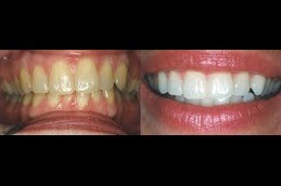 Does Whitening Weaken Your Teeth Clinic in Abu Dhabi