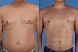 Everything You Need To Know About High-Definition Liposculpture in Dubai